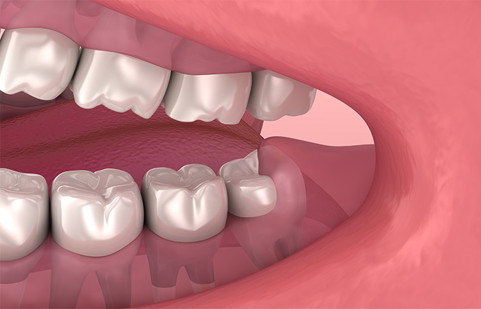 半分歯ぐきに埋まっている