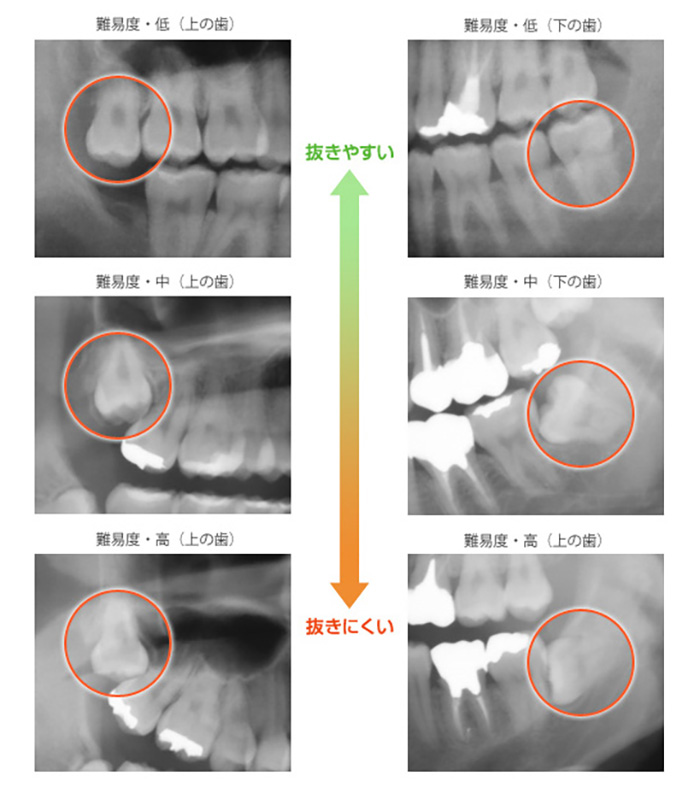 親知らず抜歯の難易度